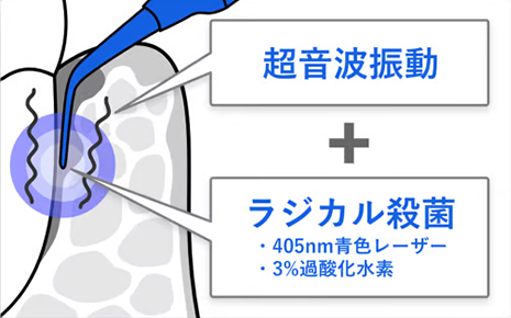超音波振動 + ラジカル殺菌