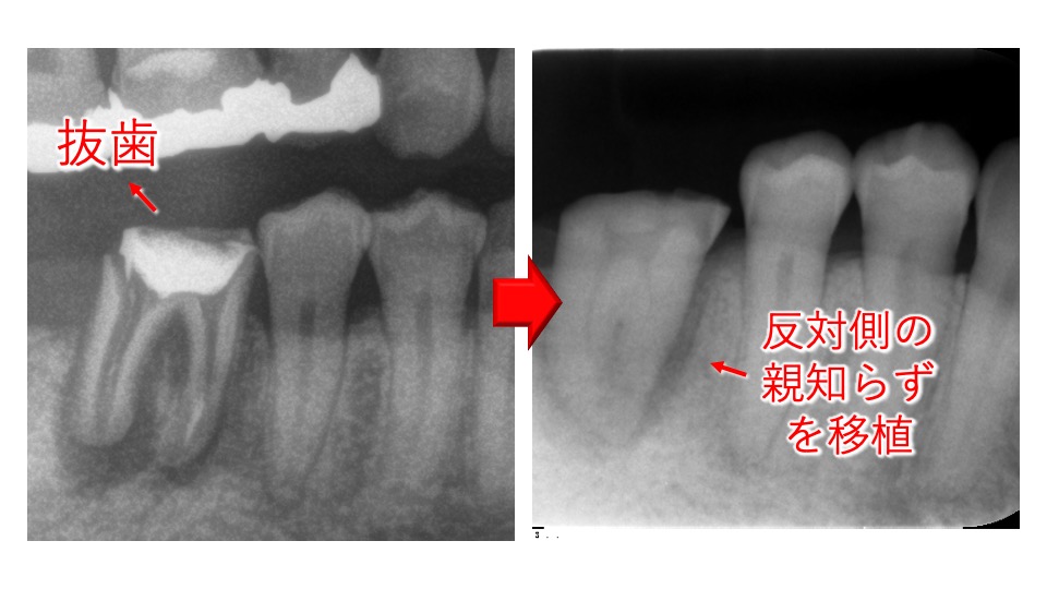 Vol 11 歯の移植 親知らずの歯を 反対の奥歯に移植して喜ばれた症例