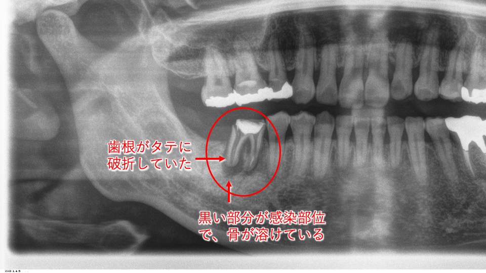 Vol 11 歯の移植 親知らずの歯を 反対の奥歯に移植して喜ばれた症例