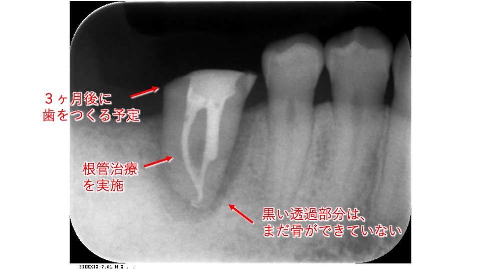 Vol 11 歯の移植 親知らずの歯を 反対の奥歯に移植して喜ばれた症例