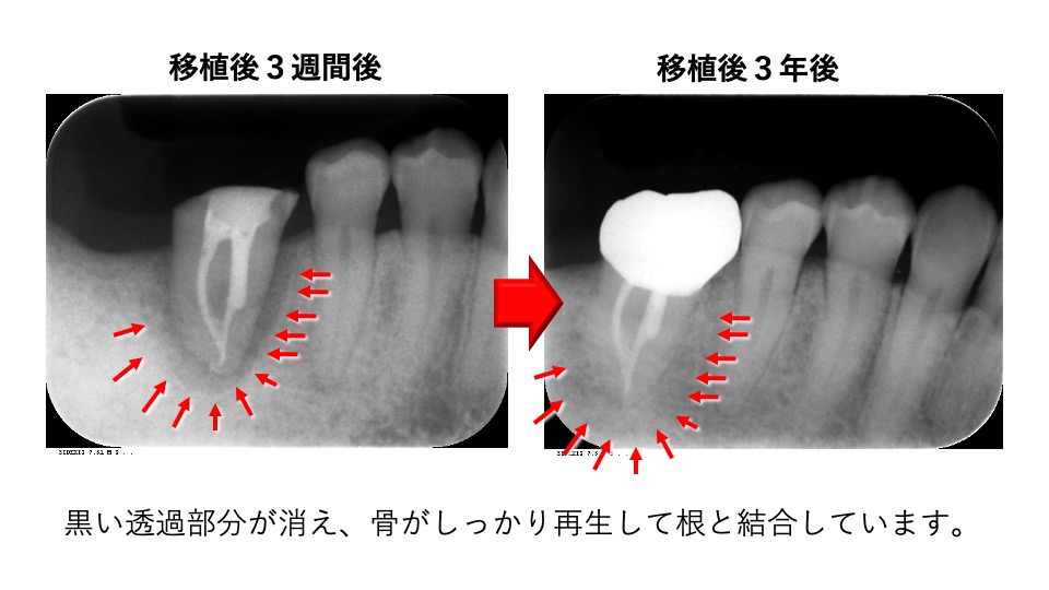 Vol 11 歯の移植 親知らずの歯を 反対の奥歯に移植して喜ばれた症例