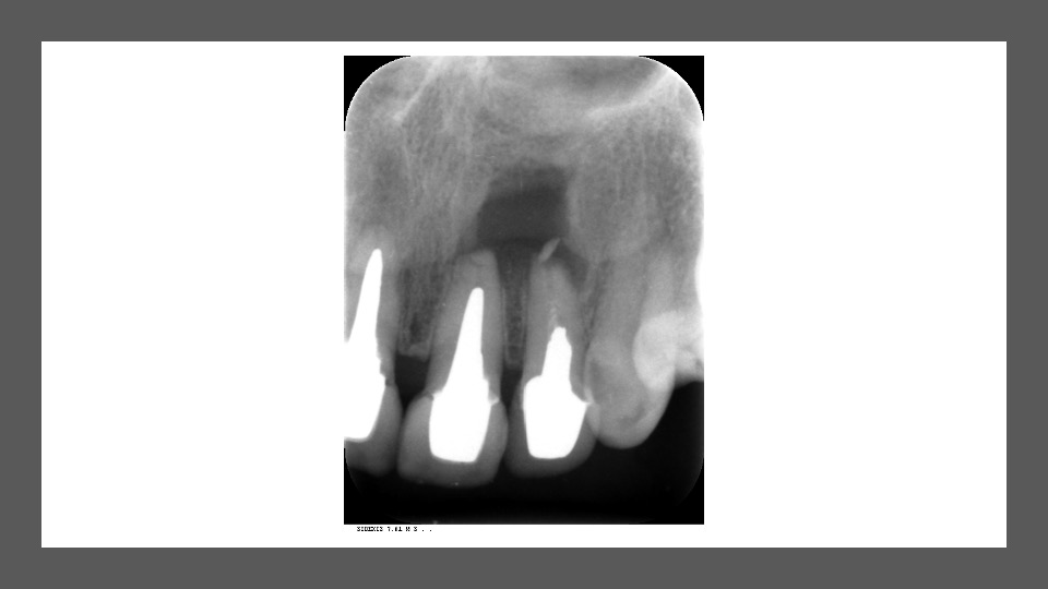 vol.10　当院では、保険治療で「CT診断・マイクロスコープ精密治療・歯根端切除術」ができます。