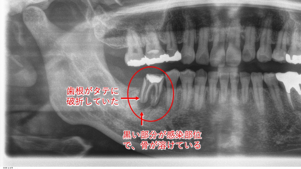 vol.11　歯の移植（親知らずの歯を、反対の奥歯に移植して喜ばれた症例）